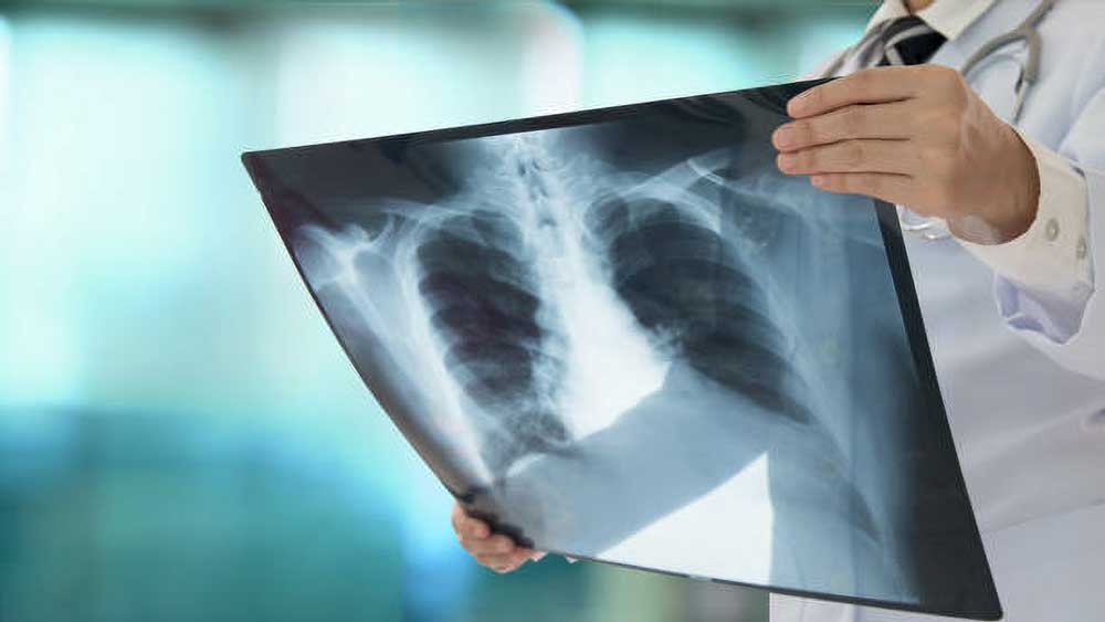 Έρευνα: Ένα χάπι για τον καρκίνο του πνεύμονα δίνει υποσχέσεις